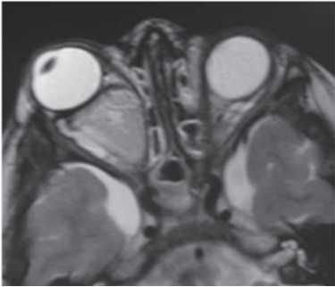 MR attēlos redzama gliomas izplatība labās puses orbītā