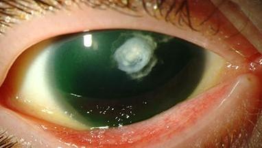 Anirīdijas acs ar apduļķotu lēcu jeb kataraktu