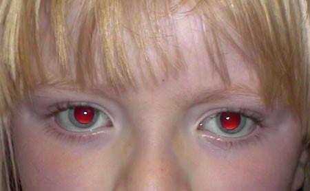 Paciente ar acu jeb okulārā albīnisma formu