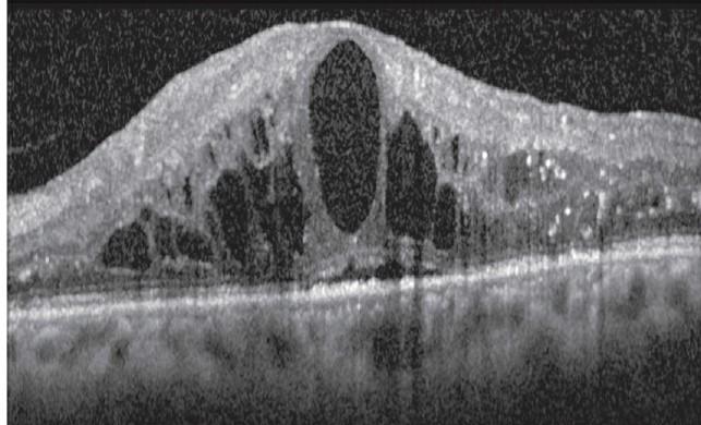 Okulokoherentās tomogrāfijas attēls – cistveida makulas tūska