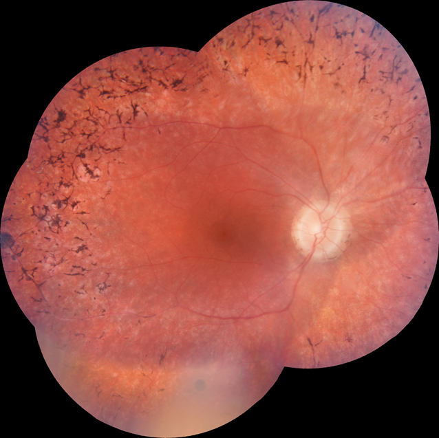 asera sindroms-nogulsnes acī