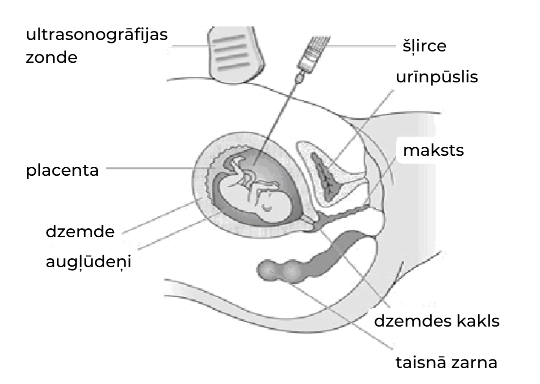 Amniocentēzes norise