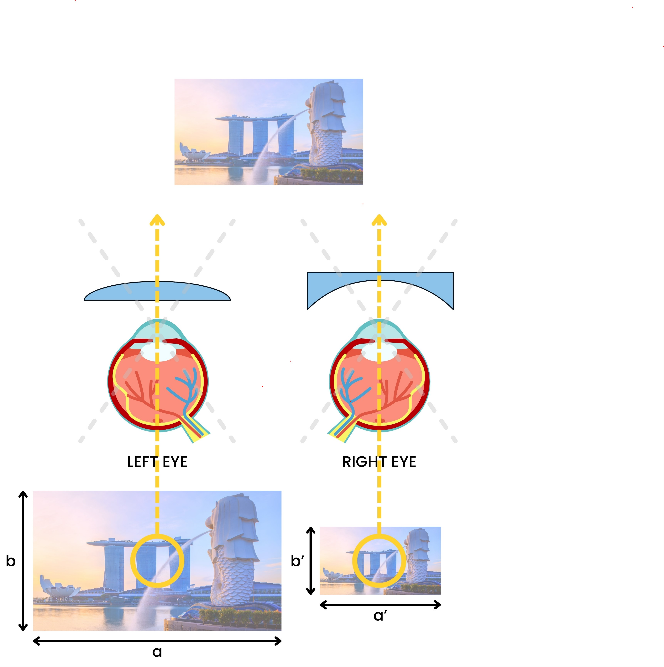 Jauktā anizometropija